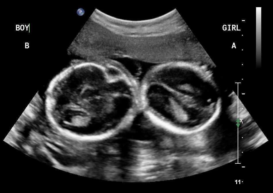 Ultrasound Photo